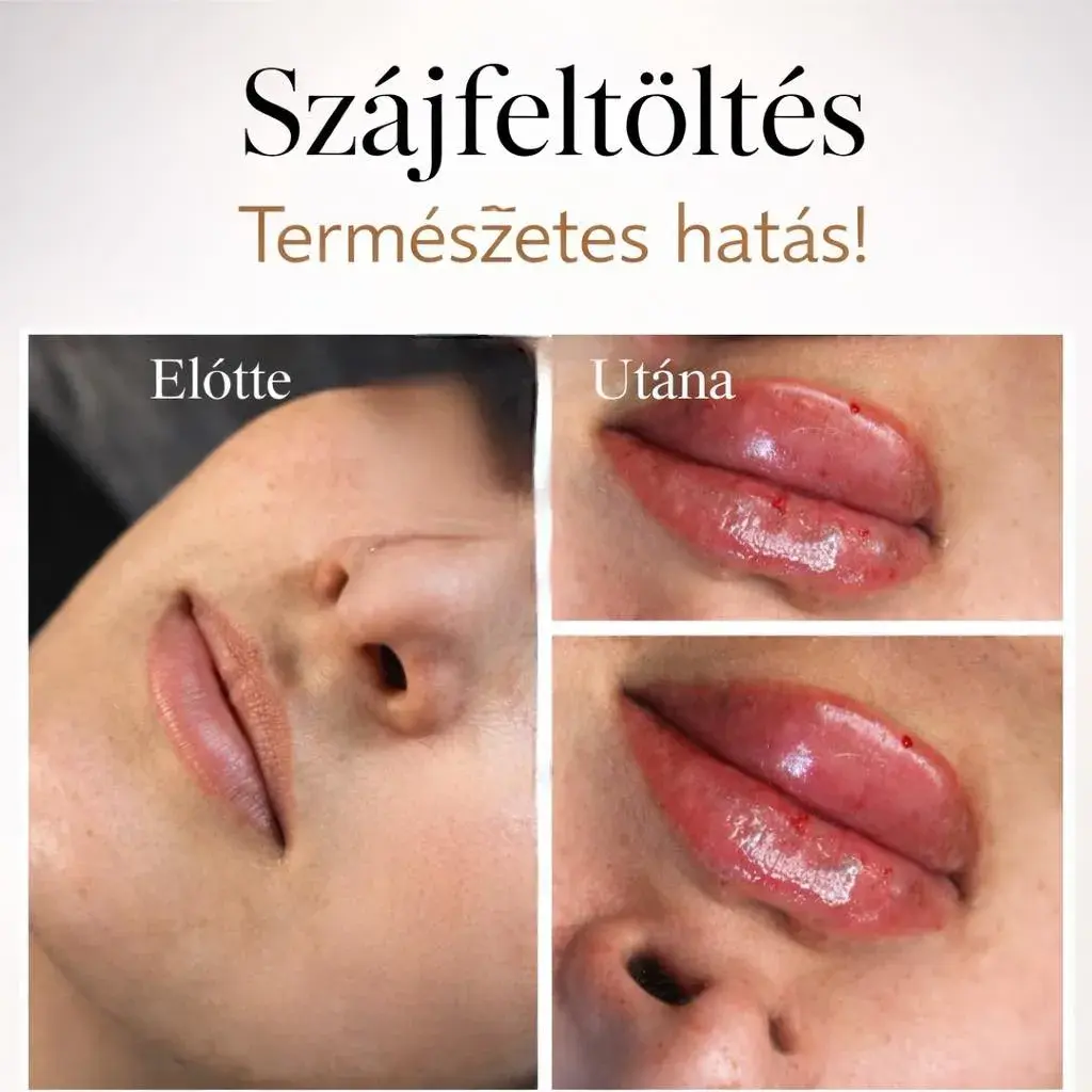 Szonja Beauty Salon – kezelés 15