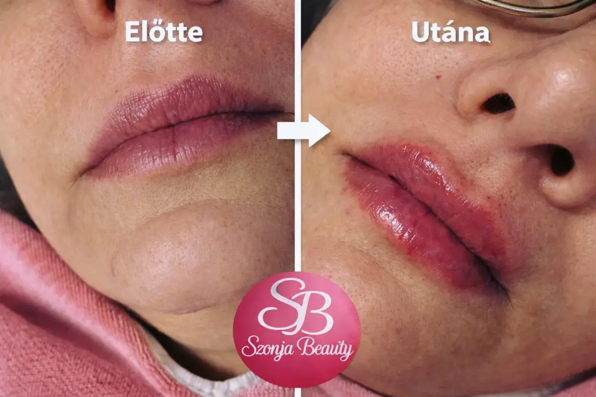 Szonja Beauty Salon – kezelés 23