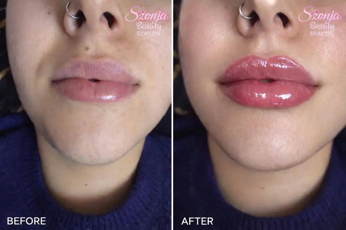 Szonja Beauty Salon – kezelés 26